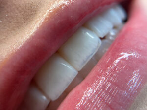 Facetas dentárias de resina